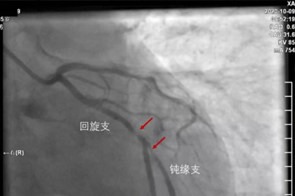 caFFR為復旦大學附屬中山醫院吳淞醫院提供準確冠脈功能評估，引導精準介入治療